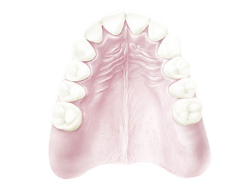 Treatment Class II Malocclusion