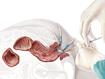 ileo neo rectal anastomosis